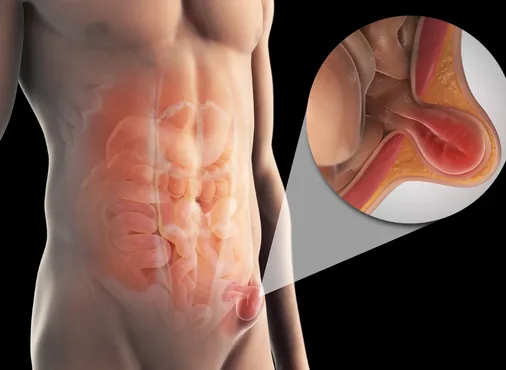 Inguinal Hernia consultation at Niraaya Hospital